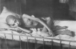 Anonymous - Girl victim of  dystrophy